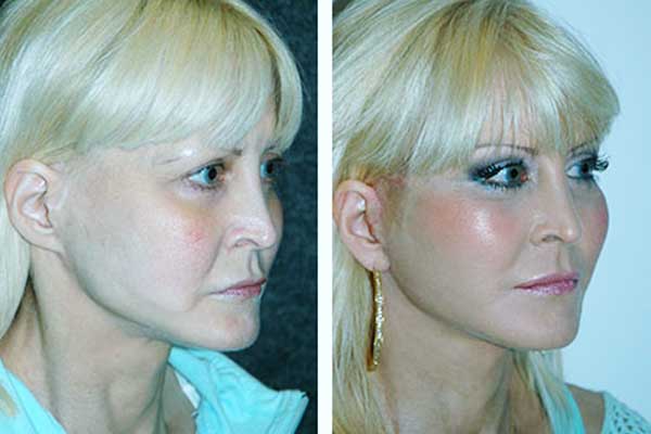 📸 قبل وبعد