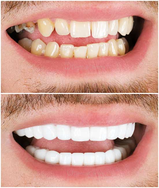 📸 قبل وبعد