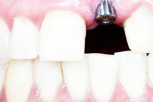 زراعة الأسنان في الفك العلوي