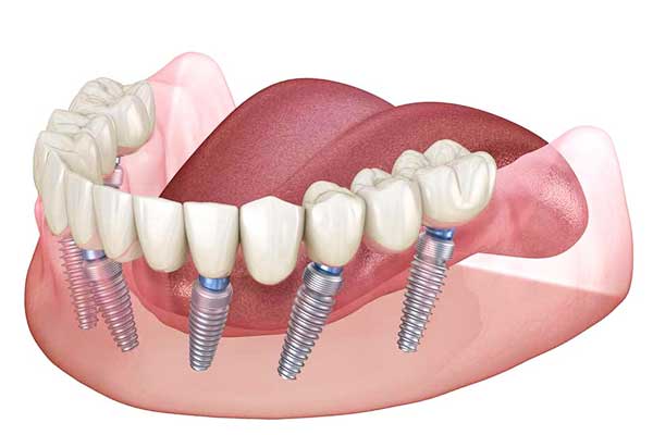 تكلفة زراعة طقم أسنان كامل